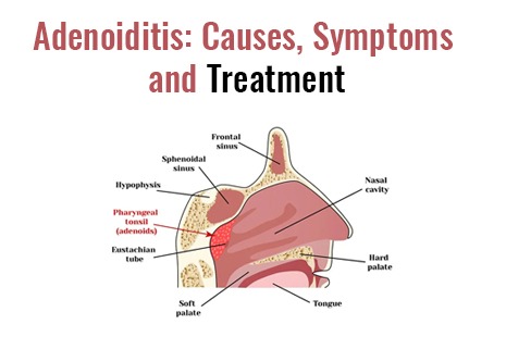 Adenoiditis: Causes, Symptoms And Treatment