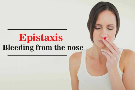 Epistaxis – Bleeding From The Nose